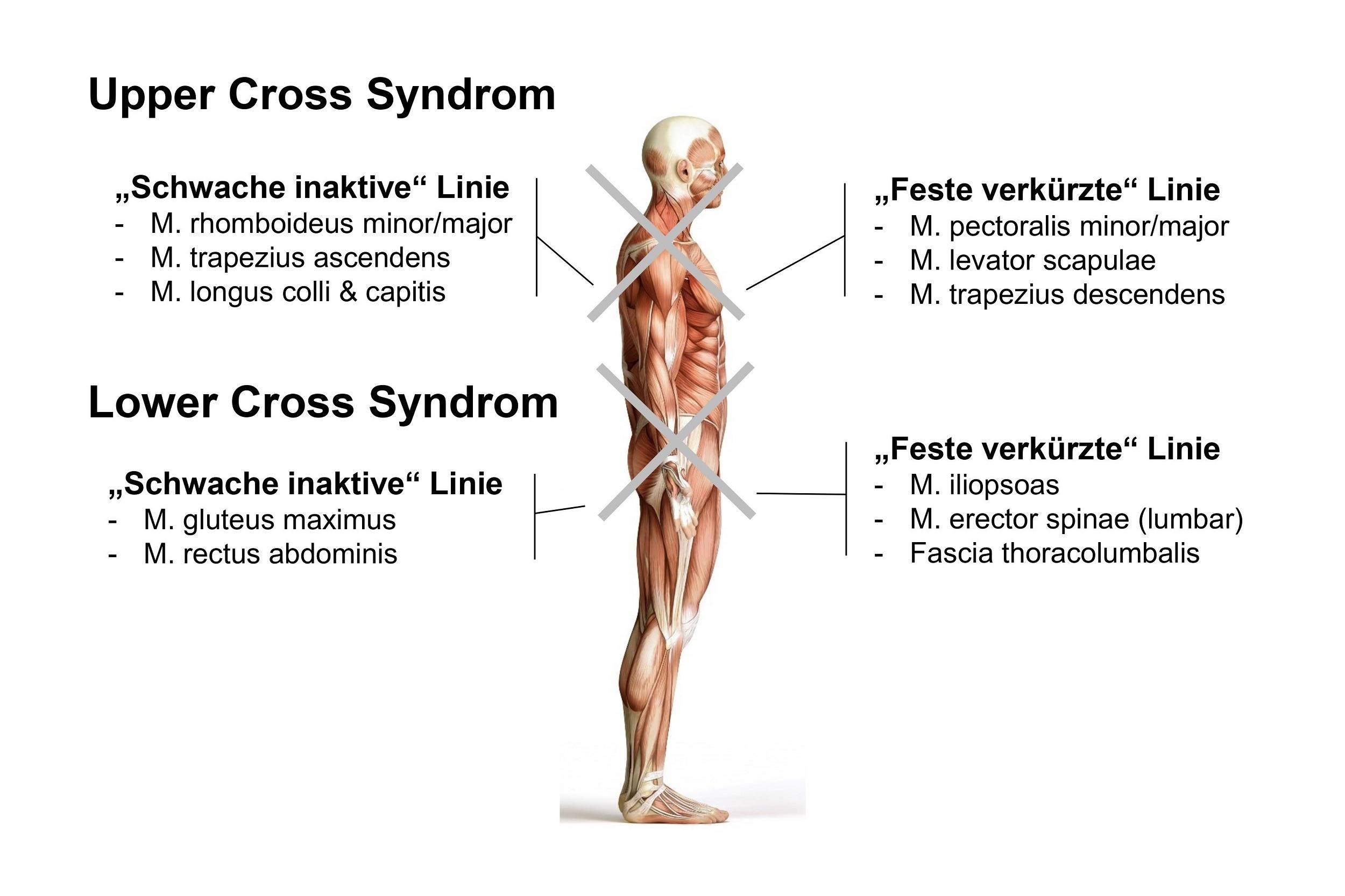 Lower und Upper Cross Syndrom